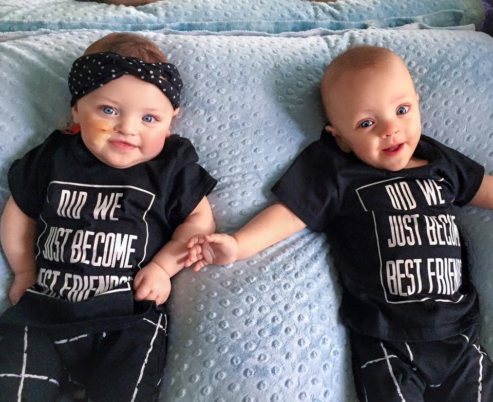 The twins do have some lasting health problems