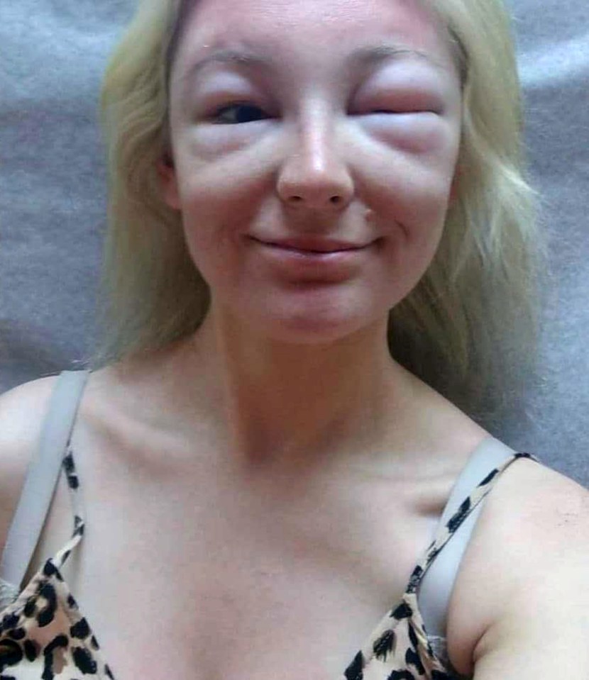 Lauren, an NHS worker, suffered the reaction while on holiday in Barbados in 2019