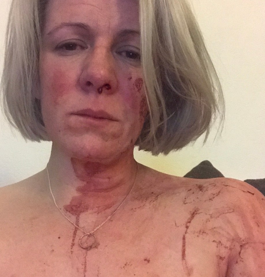 Christine covered in blood after drunken fall at bar