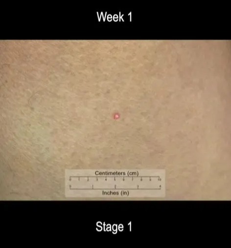 Footage shows how a tiny red spot develops into skin cancer