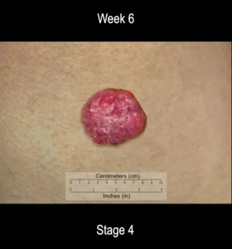 It begins as something barely visible and grows into a large red lump