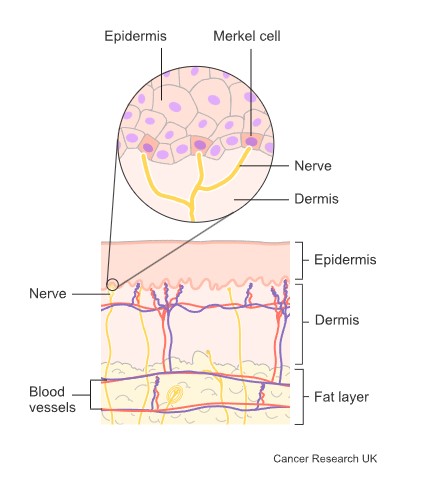 Merkel cell carcinoma starts in the Merkel cells, which are usually in the top layer of the skin