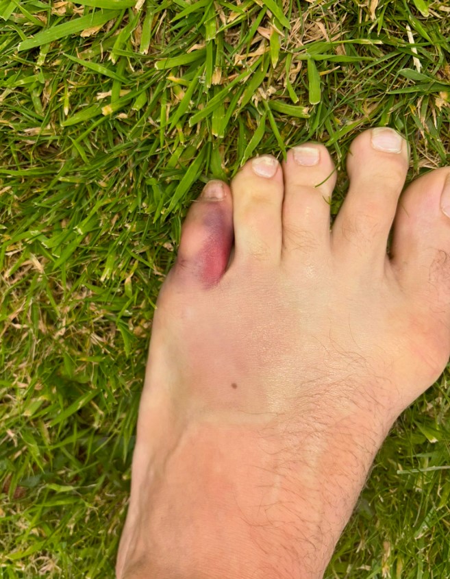 a person 's foot with a purple toenail