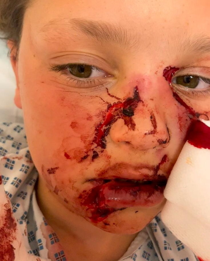 Close-up photo of a child's severely injured face after a dog attack.