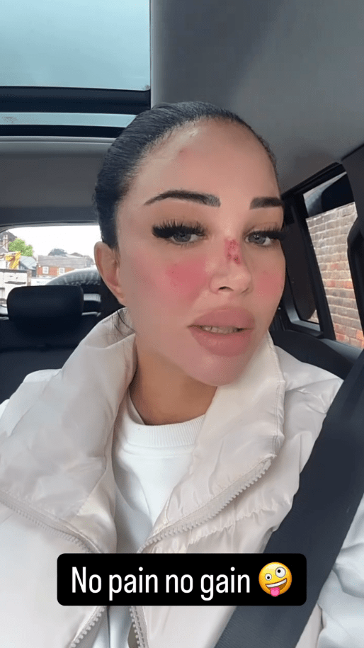 Woman in car with facial bruising, caption: "No pain no gain"