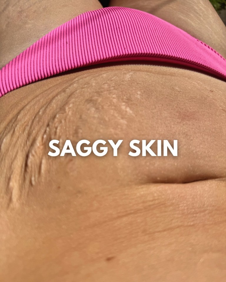 Sagging skin on a person's abdomen.