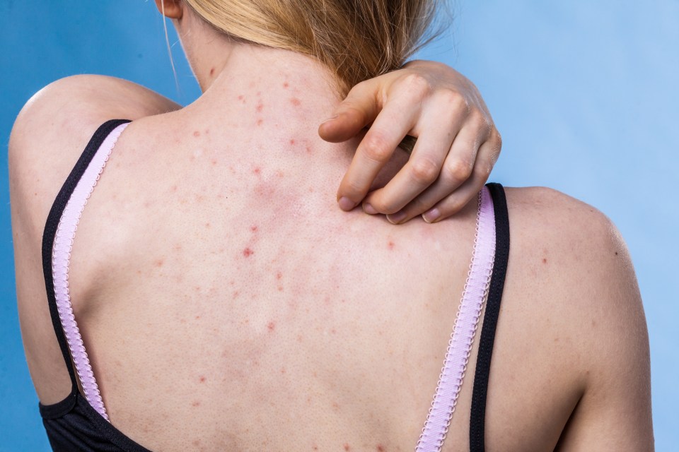 Some first get acne in adulthood, called 'adult-onset acne'