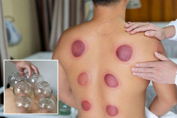 An image collage containing 2 images, Image 1 shows Asian male patient receiving cupping therapy treatment at chinese medicine shop.Traditional Chinese Medicine Treatment.Alternative Medicine,Alternative Therapy, Image 2 shows Cupping therapy being applied to a person's back