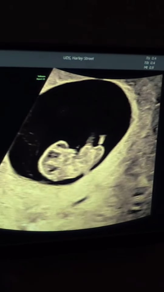 Ultrasound image of a fetus.